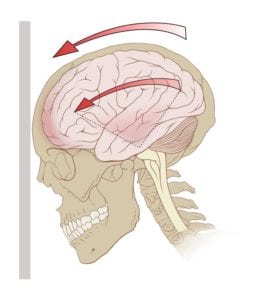 Newnan traumatic brain injury lawyers